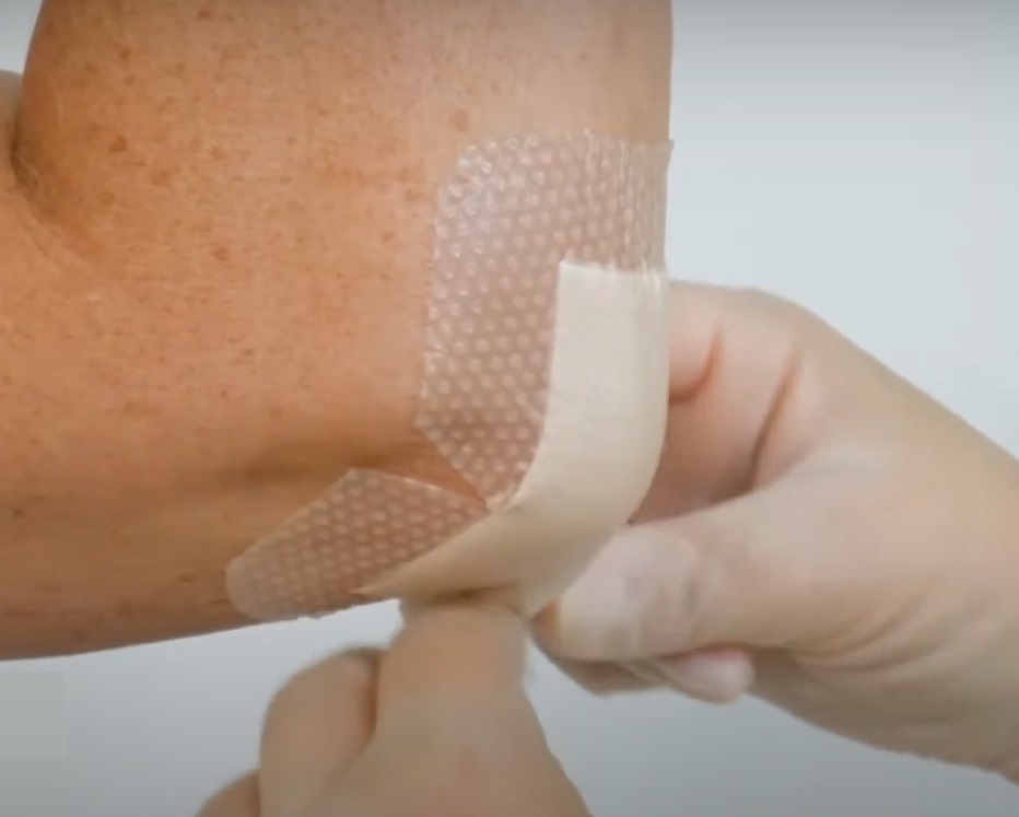 Mepilex Border Flex Lite applied on elbow